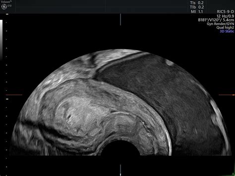 3d Ultrasounds Can Transform Postmenopausal Gynecology Empowered
