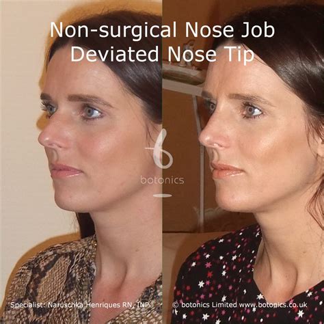 The Best Nose Job Before After Female References My Reff