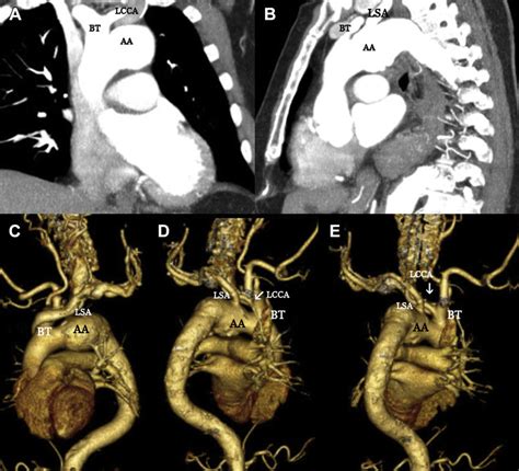 E Aeb Computed Tomography Scan Images Showing Bovine Aortic Arch
