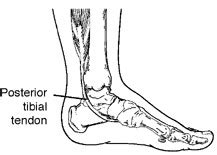 Posterior Tibial Tendon Dysfunction PTTD San Mateo Podiatry Group