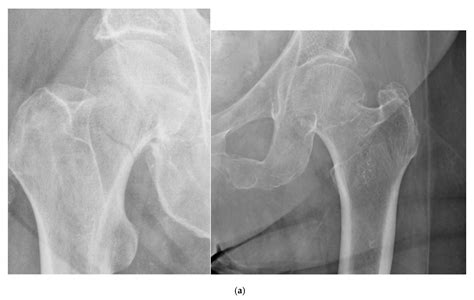 Geriatrics Free Full Text Surgical Treatment Of Femoral Neck