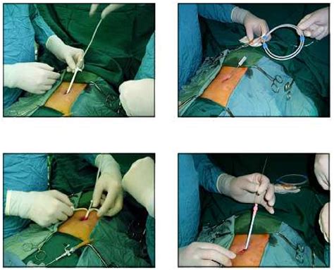 Peritoneal Dialysis Catheter Placement Procedure Hot Sex Picture