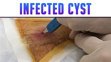 Infected Back Cyst Drained And Packed Youtube