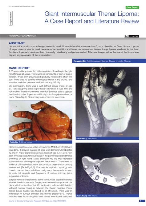 Pdf Surgery Section Giant Intermuscular Thenar Lipoma A Case Report