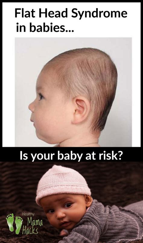Positional Plagiocephaly Is Your Baby At Risk Healthy Mama Hacks In