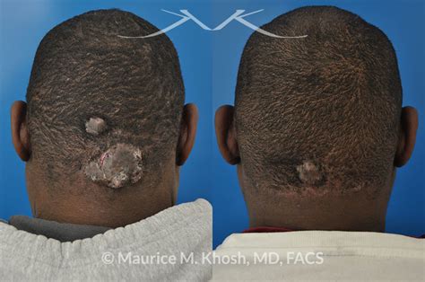 Maurice Khosh Keloid Of Scalp Due To Keloid Acne Before And After 1