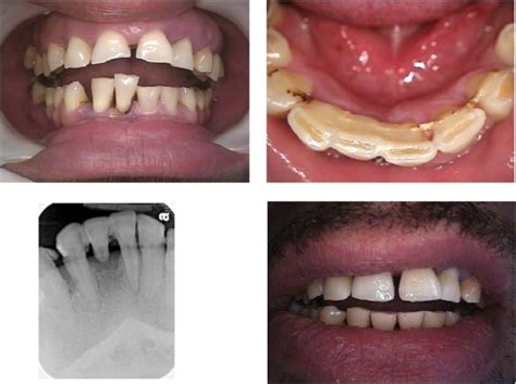 A dental splint is referred to several types of orthodontic devices that are designed. Lower splint, periodontal splinting, with tooth resection and pontic - NYC Dentist