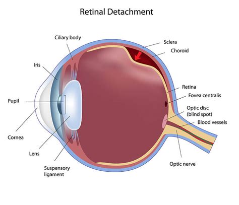The retina is the inner lining of the eye; Retinal Tears Livingston | Retinal Detachment Morristown ...