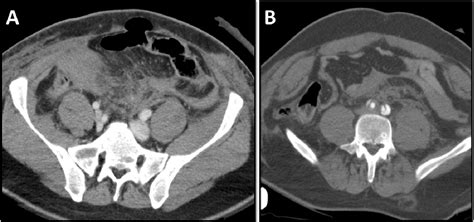 Figure 3 From Diaphragmatic And Abdominal Wall Hernias Due To Blunt