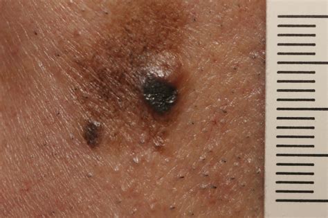 Textbook Of Skin Cancer And Melanoma