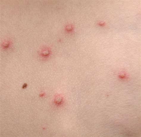 Images Of Viral Rashes MyWeb