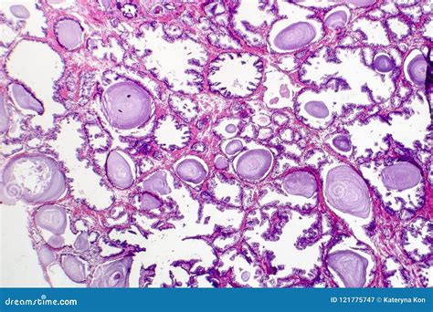 Hiperplasia Prostática Benigna Imagem de Stock Imagem de glândula tecido
