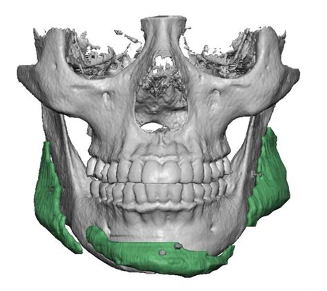 Chin And Jaw Angle Implant Asymmetries 3d Ct Scan Front View Dr Barry