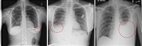 Left Small Left Pleural Effusion Middle Moderate Right Effusion