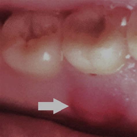 A 23 Year Old Female With A Painless Left Mandibular Swelling Oral