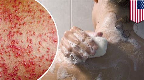 Skin Allergy Red Itchy Rashes It Might Be Preservatives In Your Bath