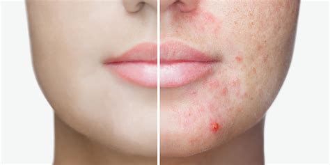 How To Manage Acne