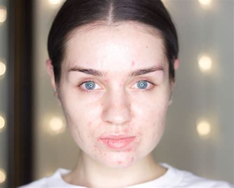 Lets Talk Acne My Skincare Routine On Accutane Mid Treatment