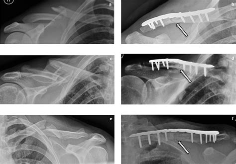 Cureus Surgical Fixation Of Clavicle Shaft Fractures Using Superior