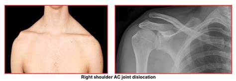 Acromioclavicular Joint Injuries Home Consultant Orthopaedic Surgeon