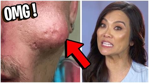 Top 7 Most Disgusting Extractions On Dr Pimple Popper Youtube