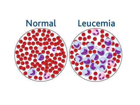 Saúde Do Adulto Leucemias