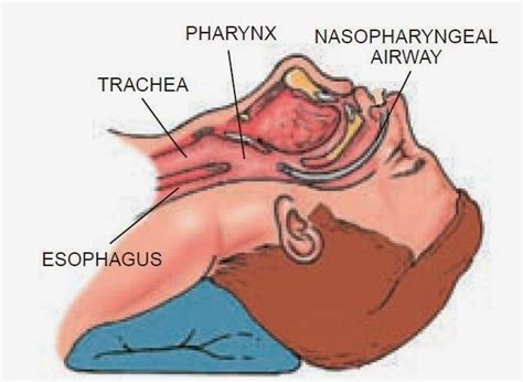 Nasopharyngeal Airway Npa Nursing