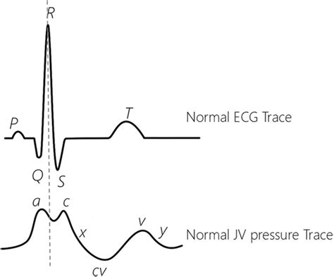 A Normal Ecg Trace On The Top And Jugular Venous Jv Pressure