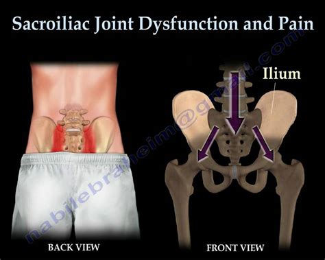 Sacroiliac Joint Dysfunction Animation Everything You Need To Know Dr Nabil Ebraheim M D