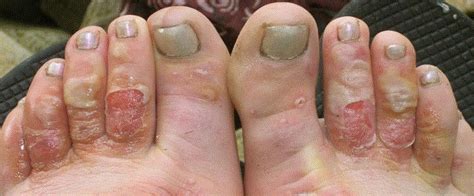 The lower end of the leg of a chair or table. Trench Foot - What Is, Treatment, Symptoms, Images, Causes