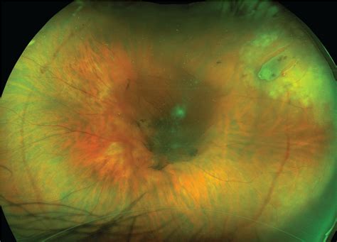 Five Evidence Based Answers For PVD Retinal Breaks