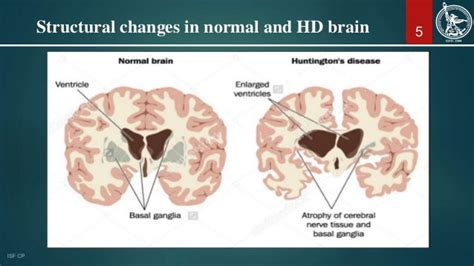 Huntingtons Disease And Its Treatment