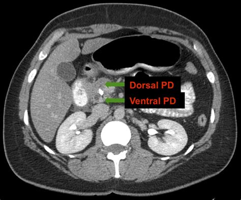 Acute Pancreatitis Pancreas Divisum With Ventral Duct Intraductal