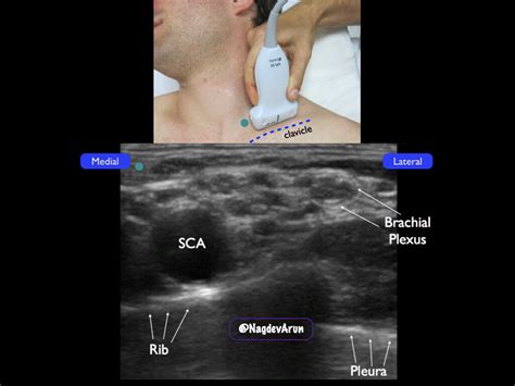 Supraclavicular Brachial Plexus Highland EM Ultrasound Fueled Pain Management