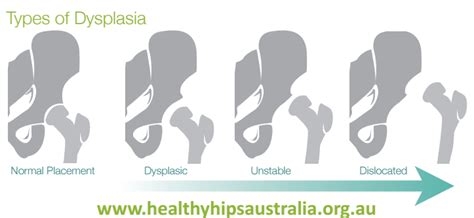 Infant Hip Dysplasia Signs And Symptoms Healthy Hips Australiahealthy