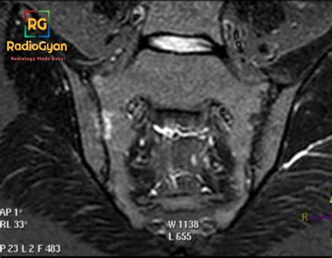 Sacroilitis Radiology Case Radiogyan