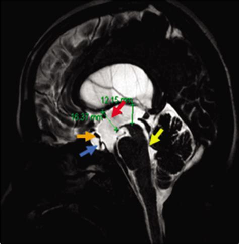 A Case Of Hydrocephalus Confounded By Suprasellar Arachnoid Cyst And