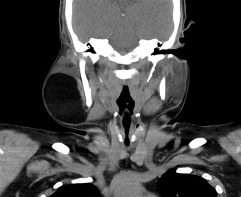 Salivary Gland Tumor Ct Wikidoc