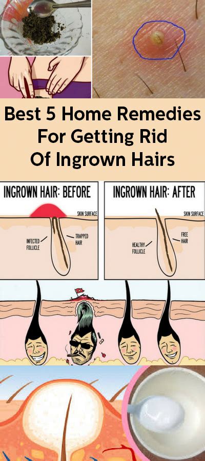 Best 5 Home Remedies For Getting Rid Of Ingrown Hairs