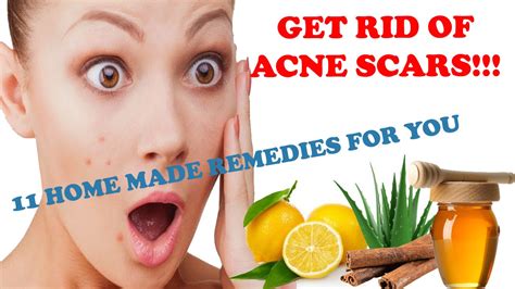 How To Get Rid Of Oily Skin And Acne Home Remedies For Acne Remedies For Pimples Youtube