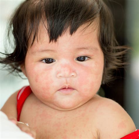 Roseola Infantum Causes Symptoms And Treatment