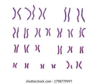 Karyotype Angelman Syndrome Labelled 3d Illustration Stock Illustration