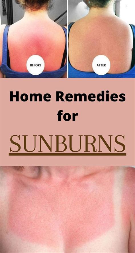 How To Get Rid Of Sunburns Fast With Home Remedies And Treatments In