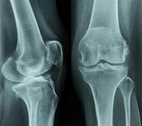 What Is The Patellofemoral Joint With Pictures
