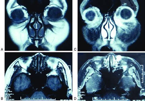 Magnetic Resonance Imaging Mri Scan Demonstrating A Axial And B