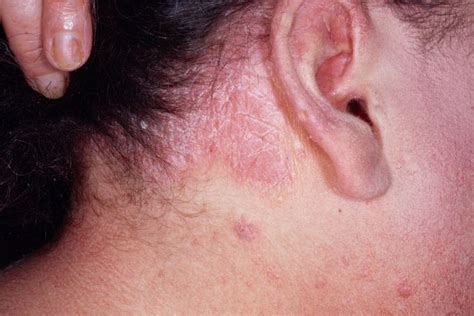 Rash Behind Ear Causes Symptoms And Treatments With Photos