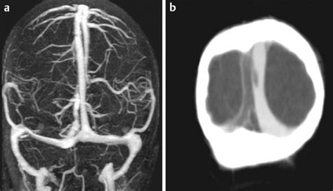 32 The Superior Sagittal And Transverse Sinuses Radiology Key