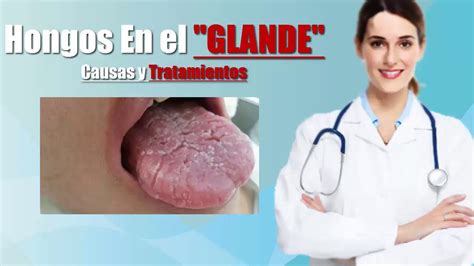 Hongos En El Gland Causas Y Tratamientos Doctora Valeria Peroski YouTube