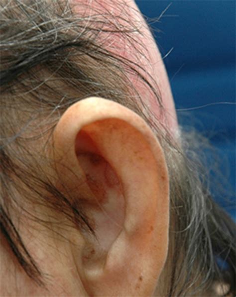 Racgp Cicatricial Alopecia A Case Study