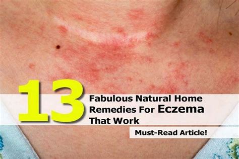 13 Fabulous Natural Home Remedies For Eczema That Work